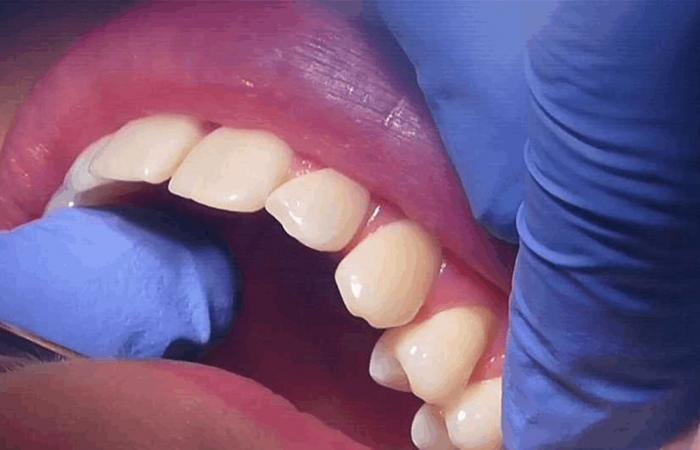 هلام ثوري يُصلح الأسنان التالفة دون جراحة