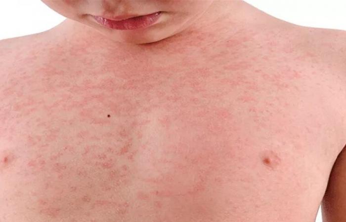 تحذيرات صحية مع تزايد حالات الحصبة