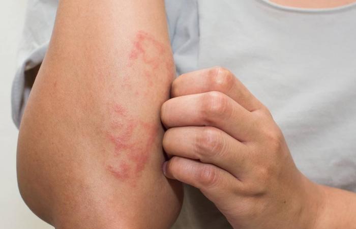 "لاصقة حرارية" تقاوم سرطان الجلد.. كيف ذلك؟