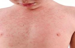 تحذيرات صحية مع تزايد حالات الحصبة